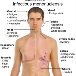 Kissing Disease Mono Symptoms - Fight Mononucleosis By Boosting The Immune System With Herbs